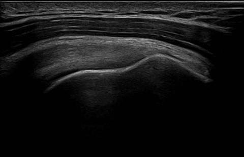 ultrasound scan of shoulder.