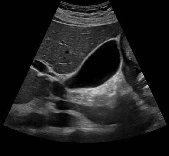 gall bladder ultrasound scan